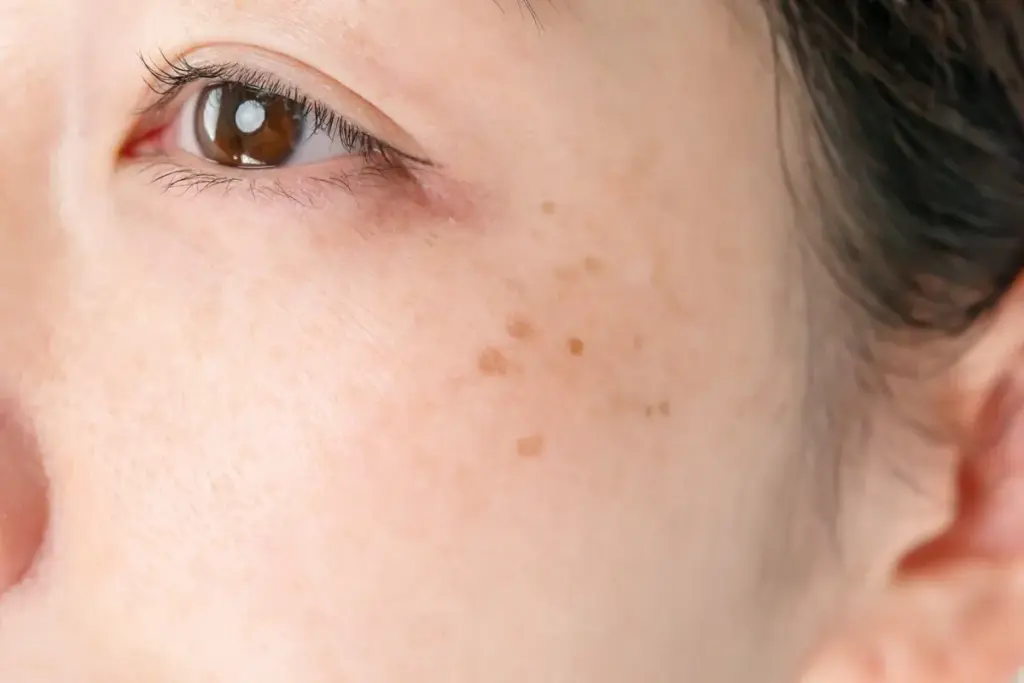 Common Types of Hyperpigmentation 