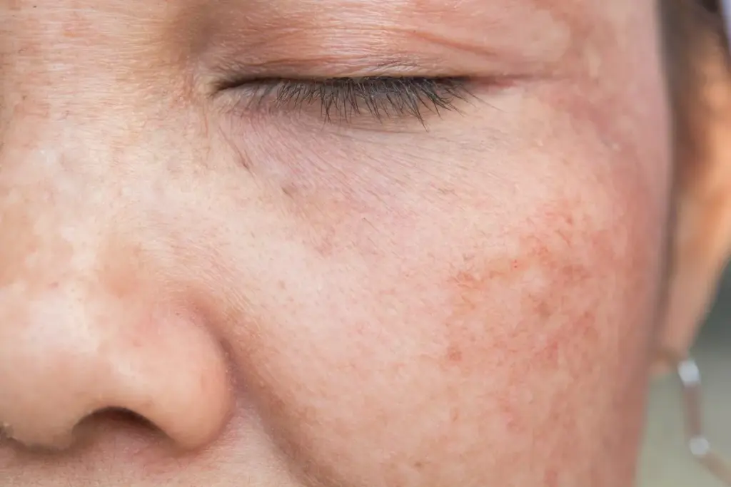 Pigmentation Removal: The Best Professional Fix 2 The Science Behind Skin Pigmentation