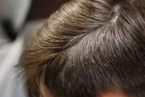 12 Common Scalp Conditions: Types, Symptoms & Treatments