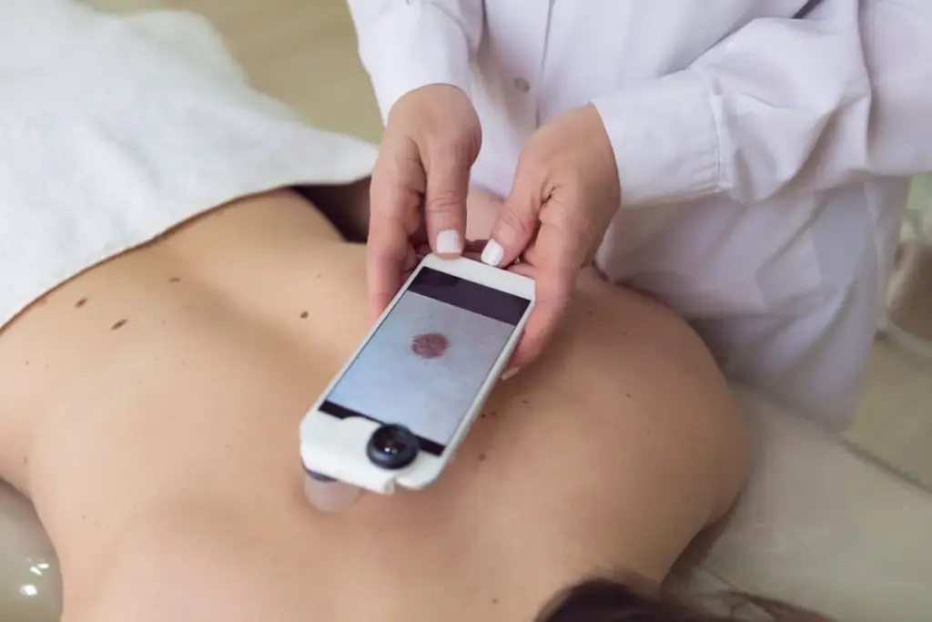 Melanoma on the Back: The Most Common Site for Men