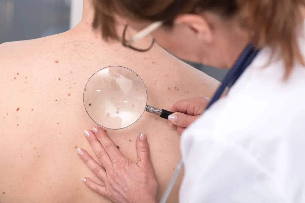 Melanoma Colors: Identify This Deadly Disease