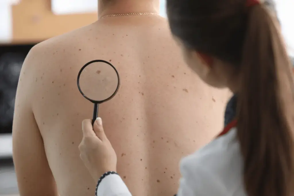 The Reality of Suspicious Moles and Cancer Risk