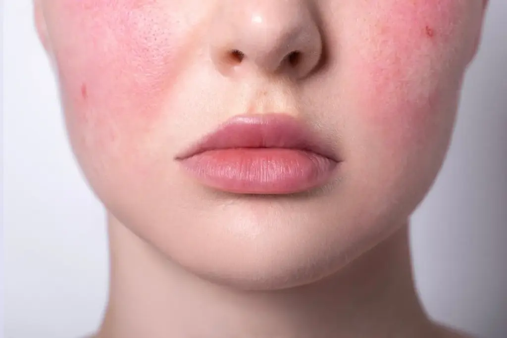4 Types of Rosacea: Understanding Each Subtype 3 4 Types of Rosacea: Understanding Each Subtype