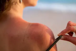 Sunburn Relief: The Coconut Oil Truth