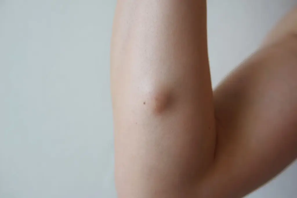 Understanding Sebaceous Cysts