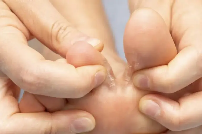 Bacterial Skin Rash vs Eczema: Know The Facts