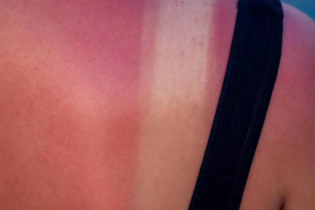 Sunburn For Black Skin: Restoring Color 1 Sunburn For Black Skin: Restoring Color