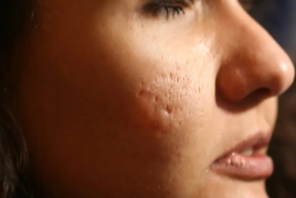 How to Get Rid of Acne Scars: Complete Treatment Guide 1 How to Get Rid of Acne Scars: Complete Treatment Guide