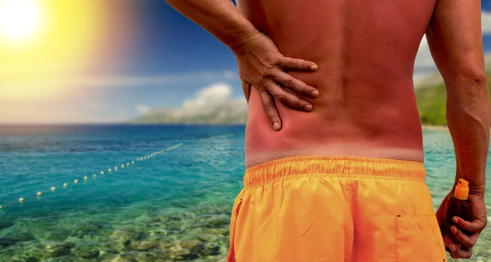 Sunburn Healing: Best Ways To Repair Skin 3 SEP 13429 image 3 LIV Hospital