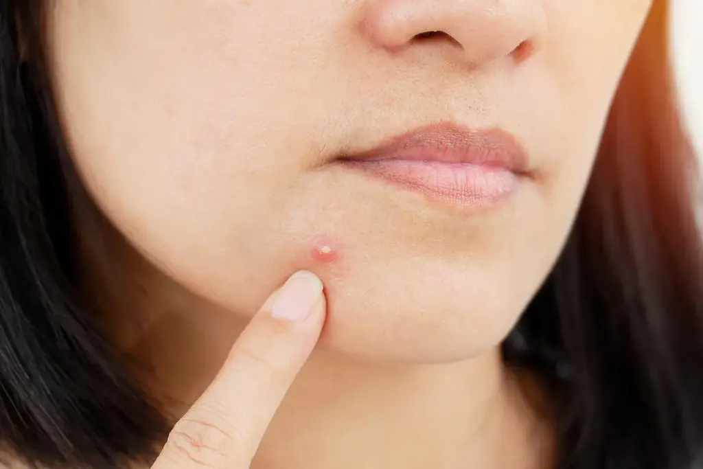 How to Get Rid of an Abscess: Complete Guide for Puss from Spot and Skin Infections 2 Understanding Abscesses: What Causes Pus-Filled Bumps and Swelling
