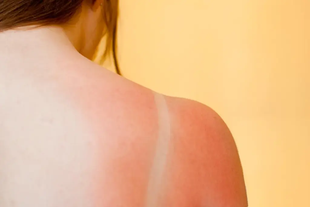 How To Get Rid Of Sunburn Redness Overnight 1 How To Get Rid Of Sunburn Redness Overnight