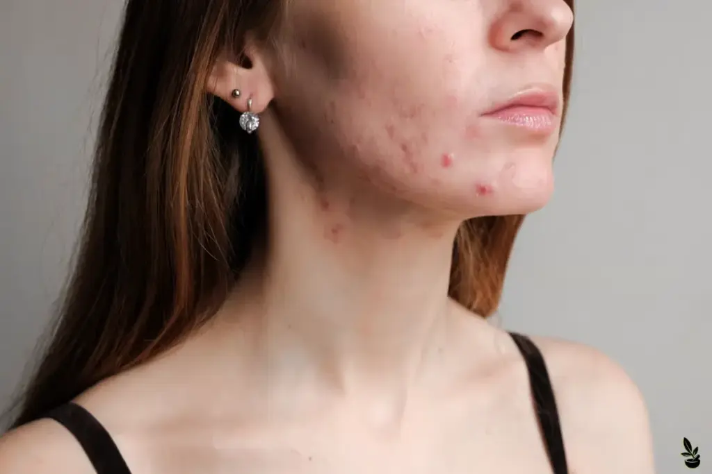 How to Get Rid of Arm Acne: Causes and Treatments