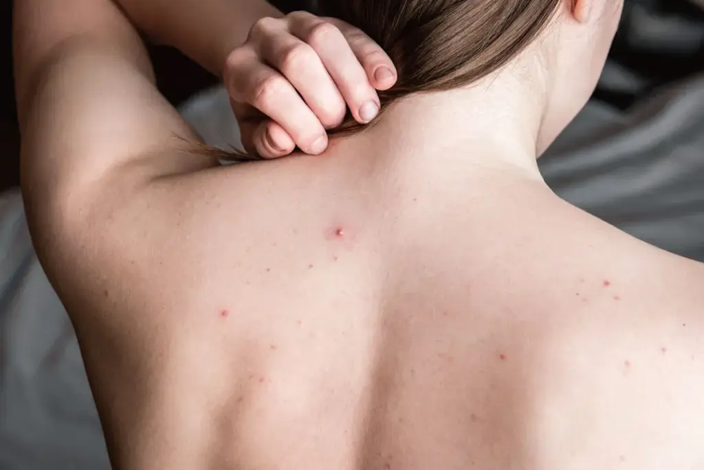 How to Get Rid of Back Acne: Best Treatments & Timeline 1 How to Get Rid of Back Acne: Best Treatments & Timeline