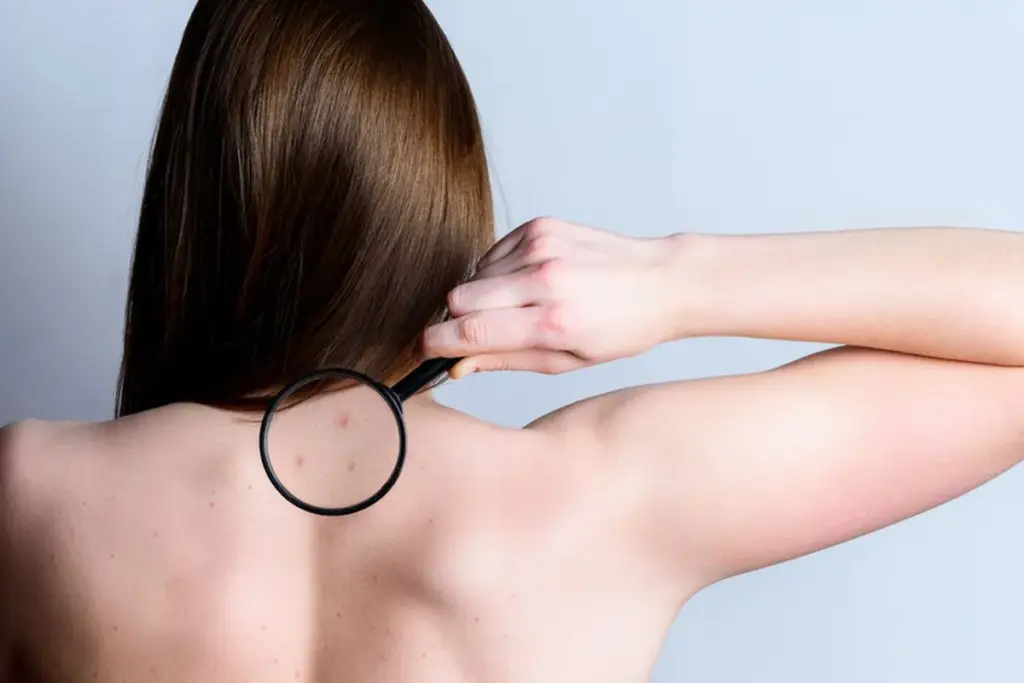 How to Get Rid of Back Acne: Best Treatments & Timeline 2 Understanding Back Acne: Why It's Different From Facial Acne