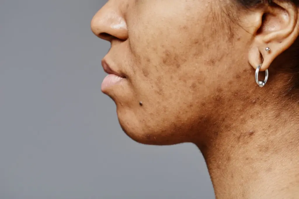 How to Get Rid of Black Spots from Acne: Effective Treatments 1 How to Get Rid of Black Spots from Acne: Effective Treatments