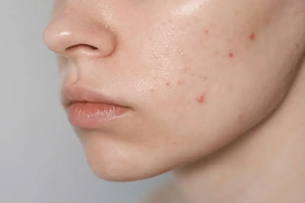 How to Get Rid of Black Spots from Acne: Effective Treatments 2 Understanding Post-Inflammatory Hyperpigmentation and Dark Acne Marks
