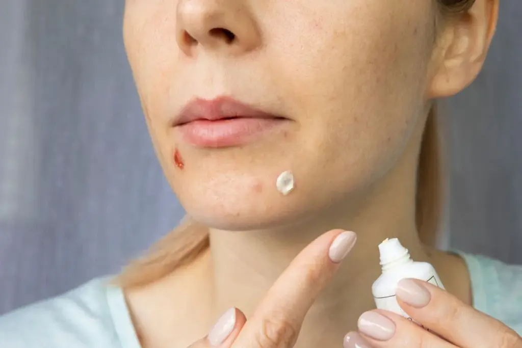 Does Toothpaste Really Help With Pimples and Acne?