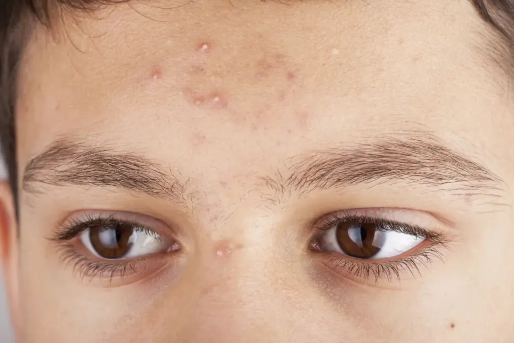 How Do You Tell the Difference Between a Wart and a Pimple? 3 How to Tell the Difference Between a Wart or Pimple