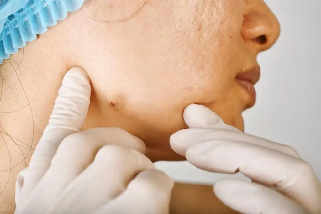How to Get Rid of Cystic Acne: Complete Dermatology Guide