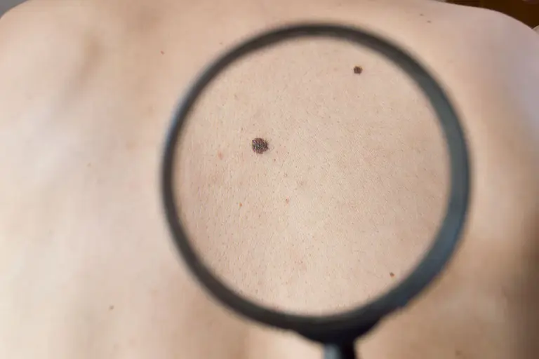 How Serious and Deadly Is Melanoma Cancer?