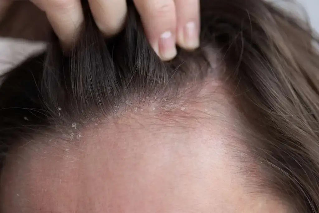 How to Get Rid of Pimples on Scalp: Complete Treatment Guide