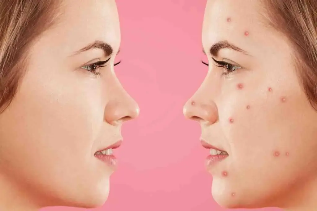 How to Get Rid of Pimples Overnight: 7 Fast Solutions