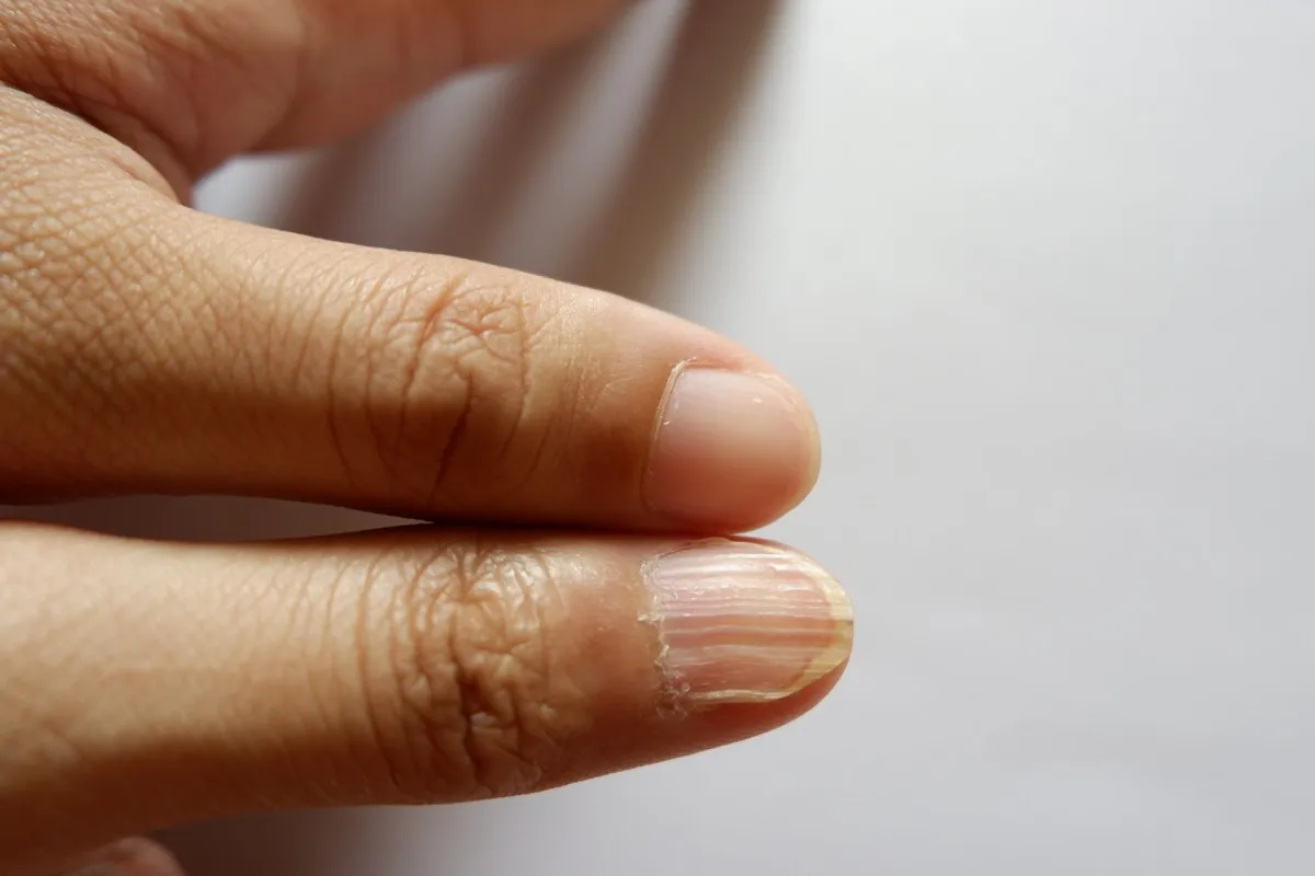 Nail Shapes: Scary Signs To Watch For - Liv Hospital