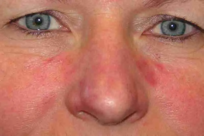 How to Get Rid of Rosacea Permanently: A Complete Guide 3 How to Get Rid of Rosacea Permanently: Proven Treatment Strategies for Long-Term Control