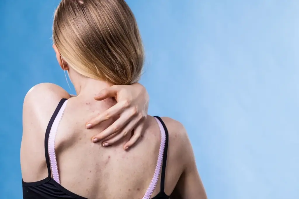 How to Get Rid of Shoulder Acne: Complete Guide 2 Understanding Shoulder Acne: Types, Causes, and Why It Happens