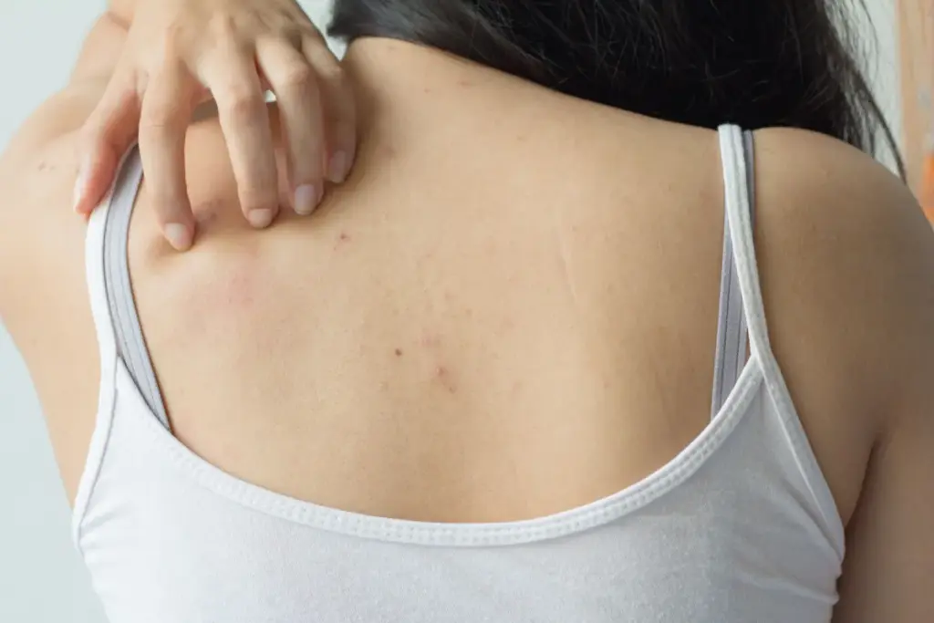 How to Get Rid of Shoulder Acne: Complete Guide 3 How to Get Rid of Shoulder Acne: Proven Treatment Methods