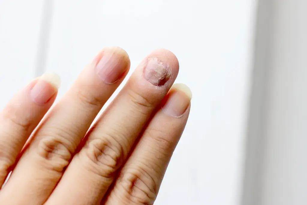 Nail Pitting: Identifying Nail Eczema 2 Understanding Nail Eczema: An Overview