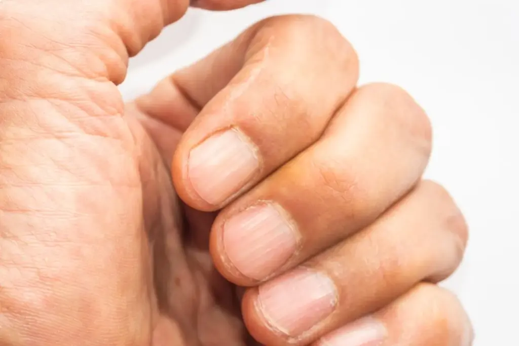 Nail Pitting: Identifying Nail Eczema 3 Common Visual Characteristics of Nail Eczema