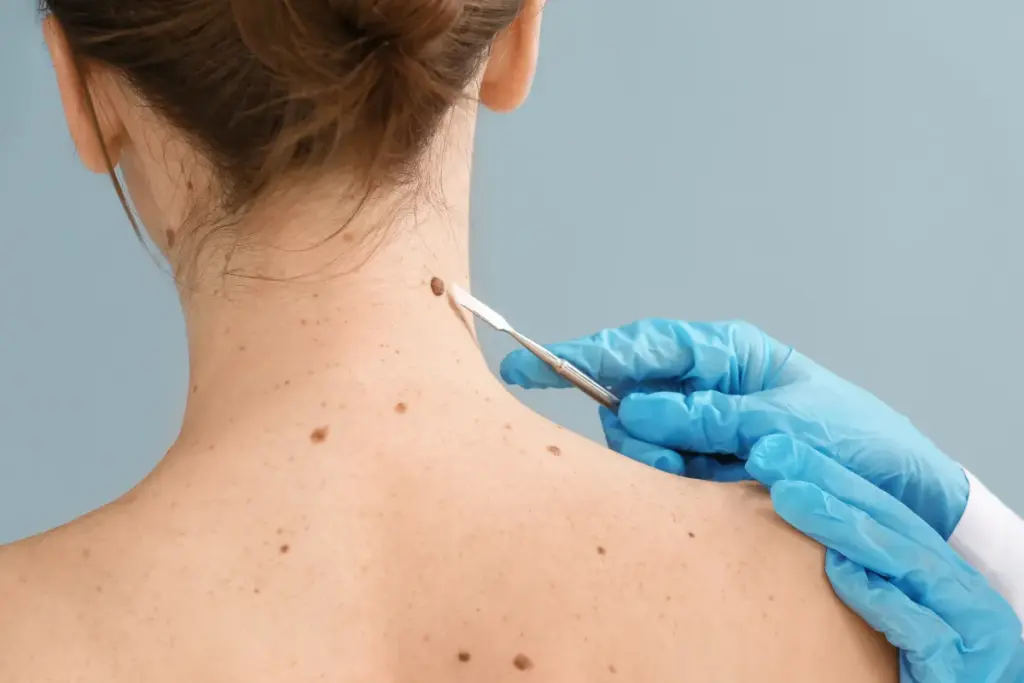 Infected Sebaceous Cyst: Why It Smells Bad