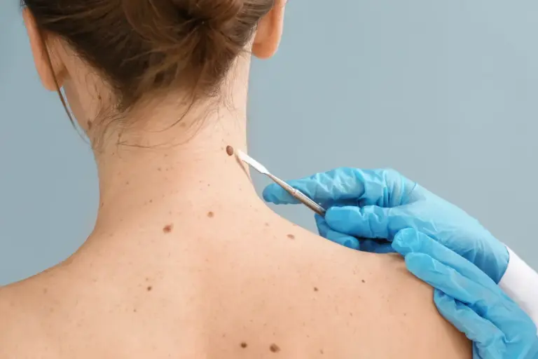 Infected Sebaceous Cyst: Why It Smells Bad