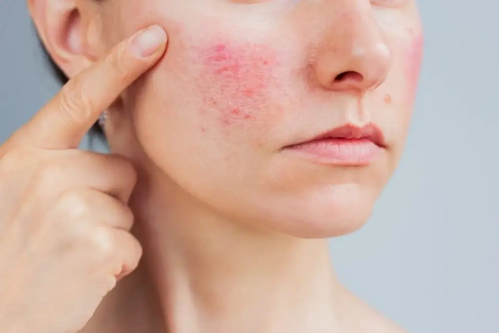 How to Get Rid of Acne Redness: 7 Proven Methods