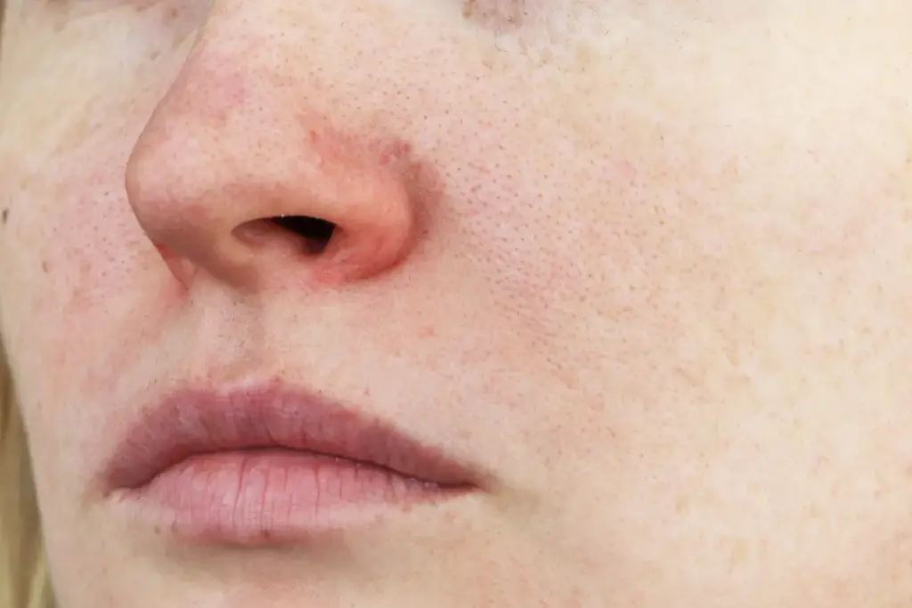 Understanding Acne Redness and Post-Inflammatory Erythema