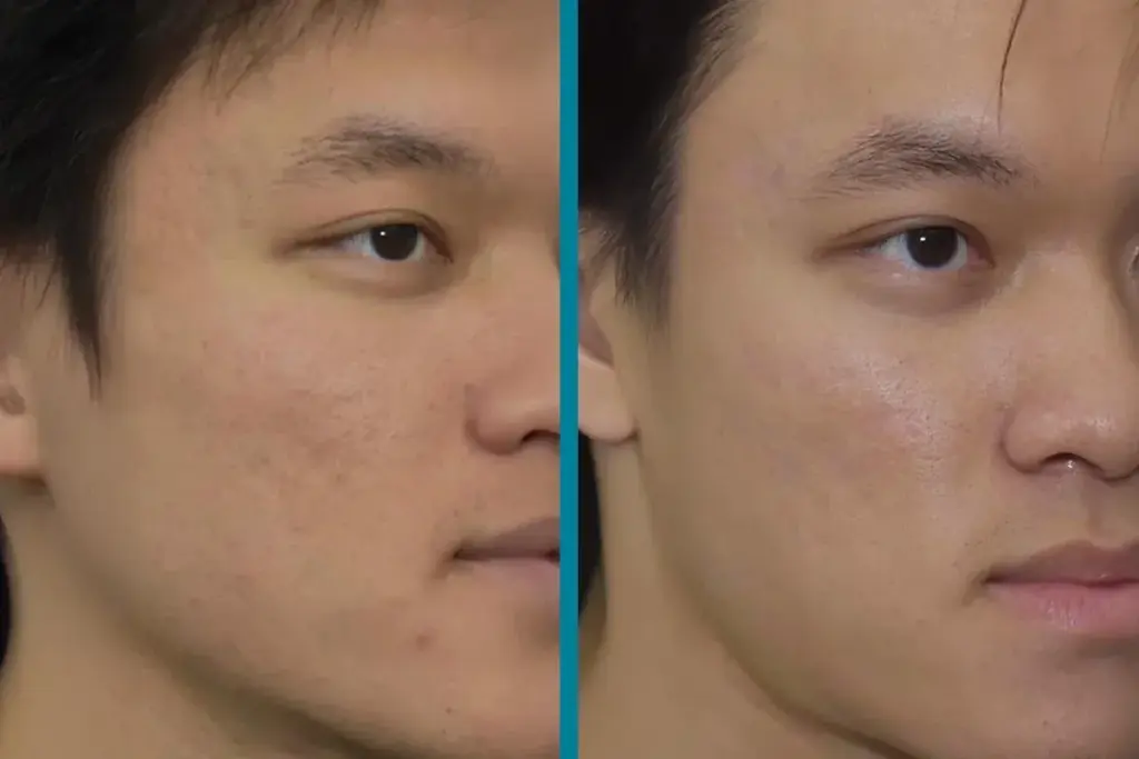 How to Get Rid of Acne Scabs Fast: 7 Proven Methods