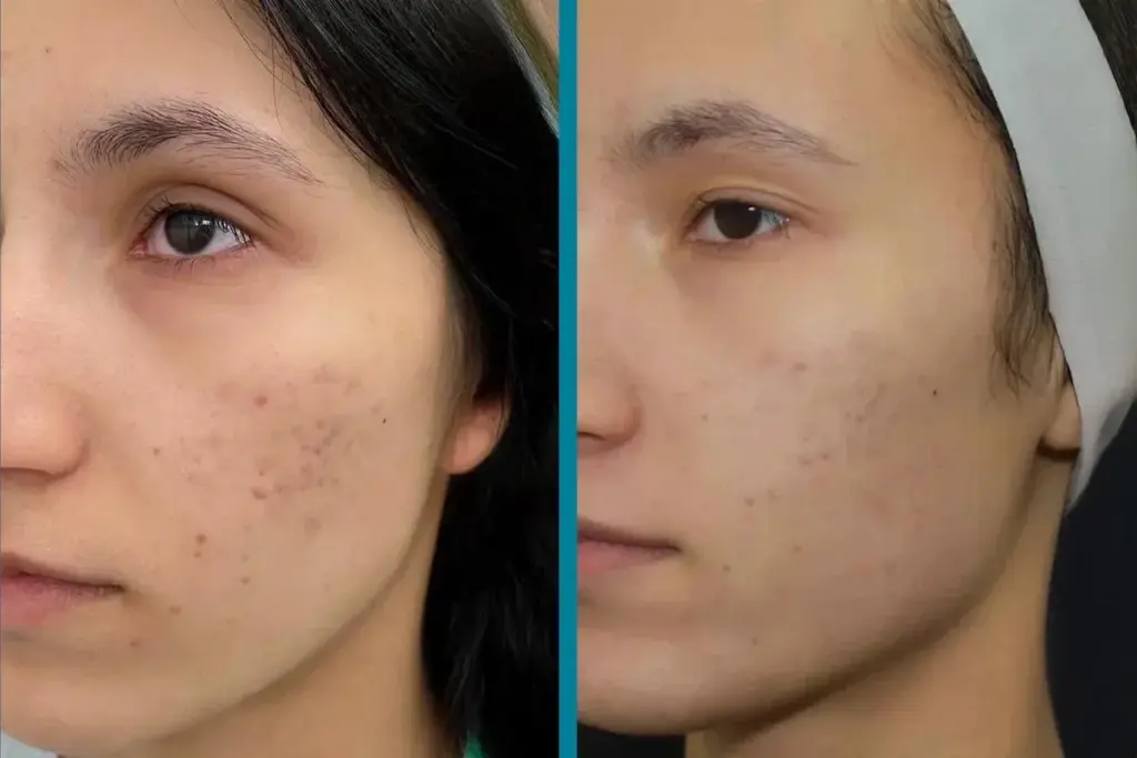 How to Get Rid of Acne Scabs: 7 Proven Methods