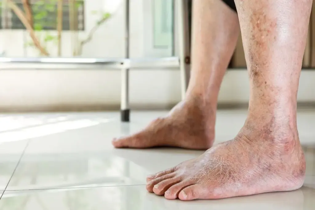 7 Skin Changes Linked to Diabetes: Signs to Watch 2 7 Skin Changes Linked to Diabetes: Signs to Watch