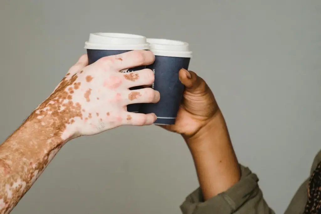 Reverse Vitiligo: Deadly Foods To Avoid 1 What foods worsen vitiligo?