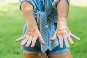Vitiligo: Quick Ways To Confirm Diagnosis