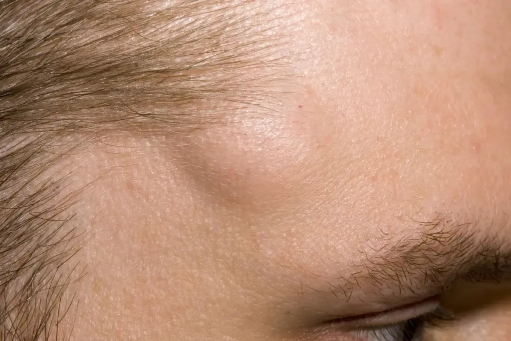 What Causes a Hard Lump on Your Head: Is It Cancer?