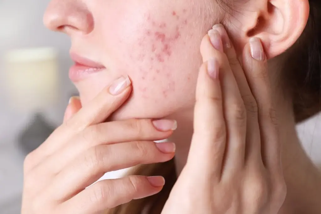 What Causes Adult Acne: Understanding Why Adults Get Pimples