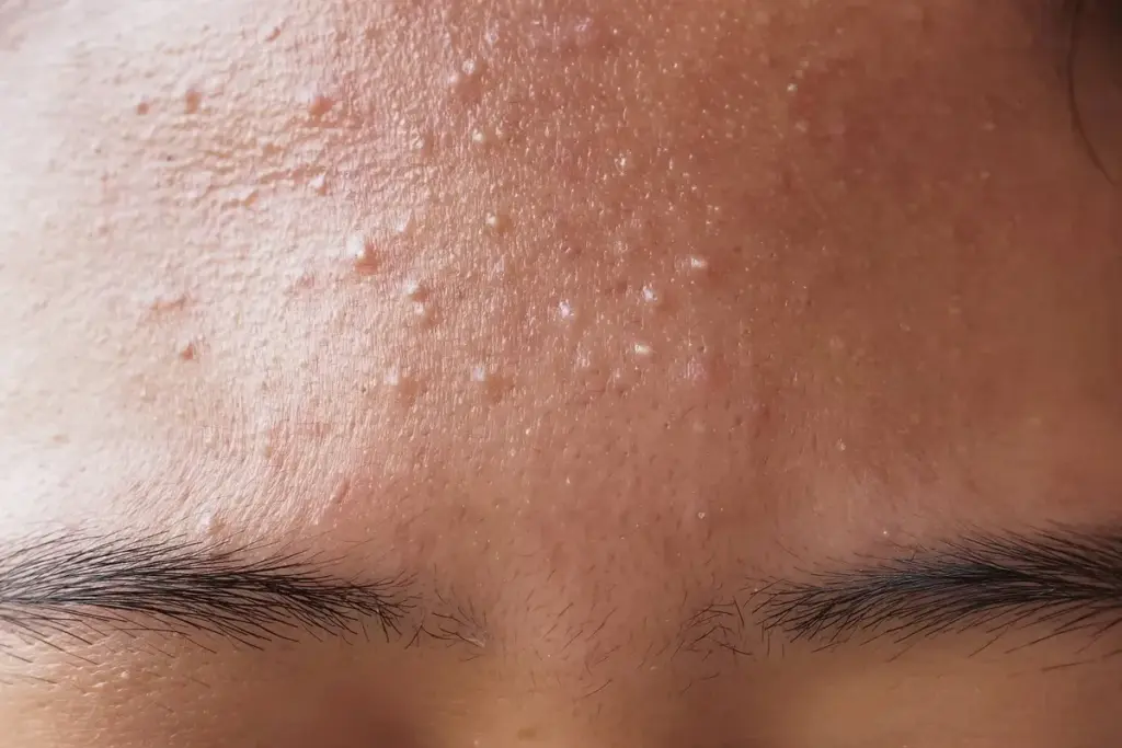 How to Treat Fungal Acne on Face: Complete Guide