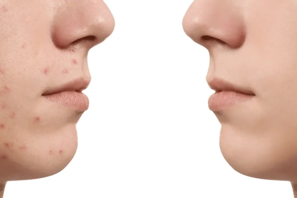 How to Treat Fungal Acne on Face: Complete Guide