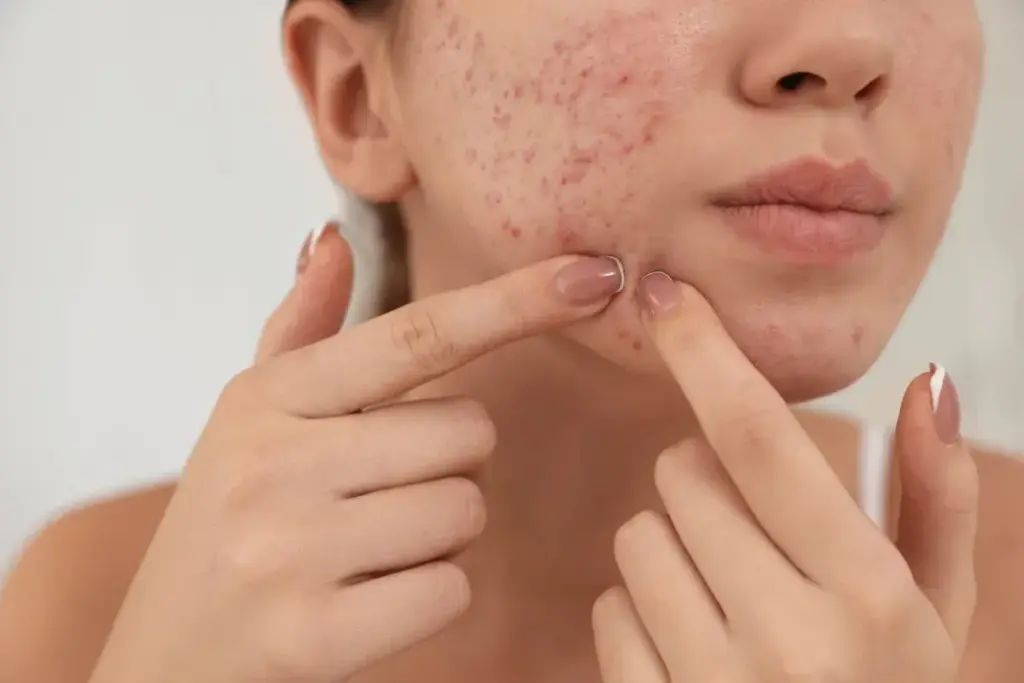 How to Treat Fungal Acne on Face: Complete Guide