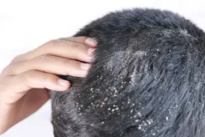What Causes Dandruff in Hair and How to Manage It?