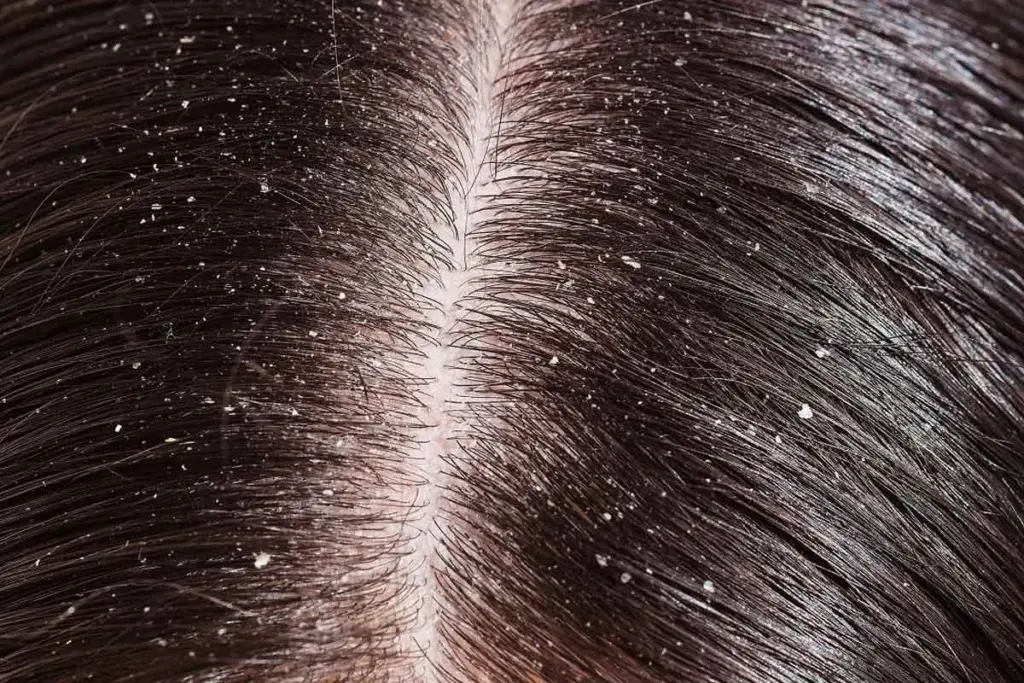 What Causes Dandruff in Hair