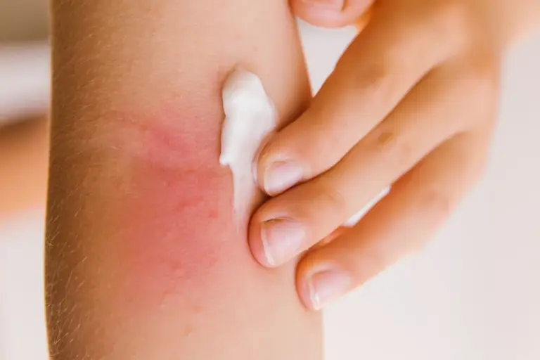 Is Eczema Fungal or Bacterial? Understanding Skin Infections