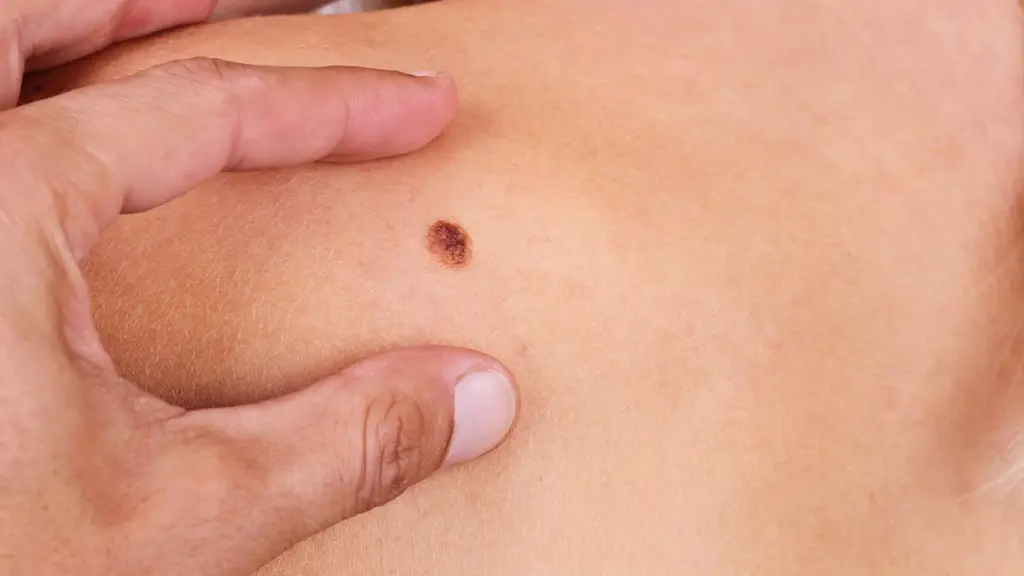 Mole Checker App: Powerful Safety Secrets 2 The Growing Concern of Skin Cancer